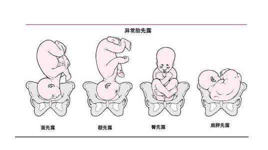 七个月臀位胎儿能否转过来？解读孕期常见问题