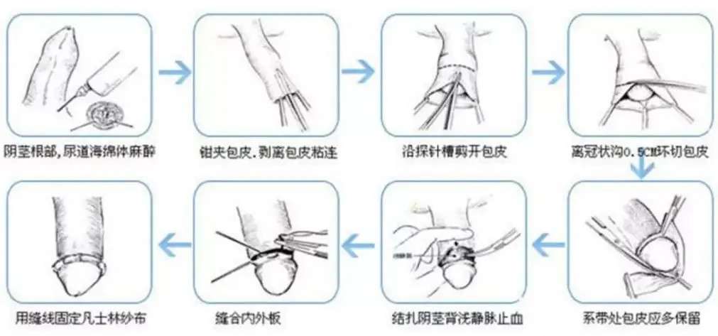 割包皮手术后的恢复与线头处理，半个月的观察与图片记录